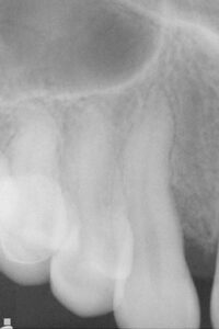 After Bone Grafting example