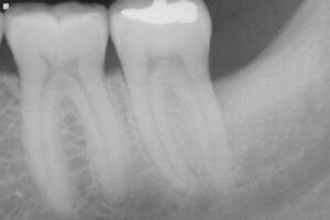 AFter Bone Grafting example