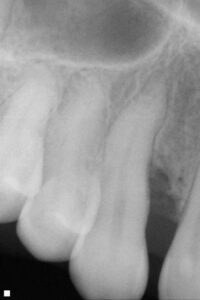 Before Bone Grafting example
