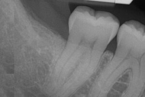 After Bone Grafting example