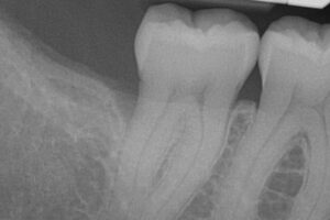 Before Bone Grafting example