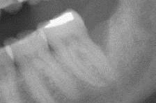 Before Bone Grafting example