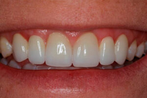 After Crown Lengthening