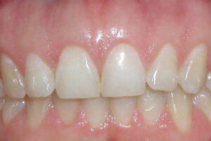 AFter Crown Lengthening