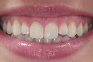 After Crown Lengthening