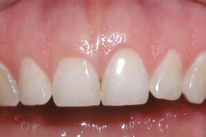 Before Crown Lengthening