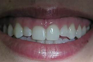 Before Crown Lengthening