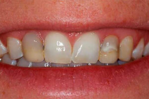 Before Crown Lengthening