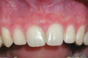 After frenectomy image