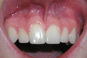 before frenectomy image