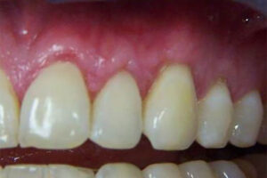 after gum grafting image