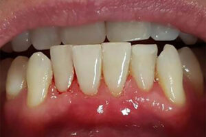 after gum grafting image