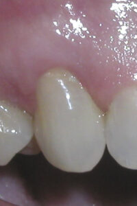 after gum grafting image