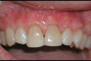 after gum grafting image