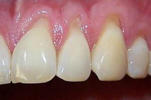 before gum grafting image