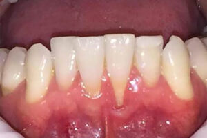 before gum grafting image