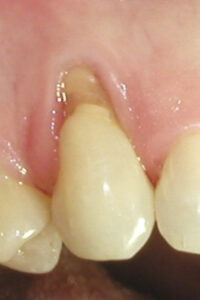 before gum grafting image