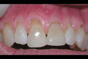 before gum grafting image