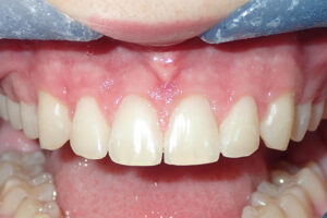 After laser periodontal therapy image
