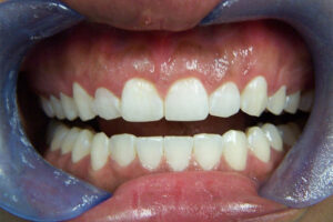 after laser periodontal therapy image