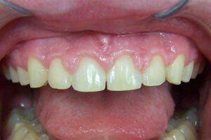 before laser periodontal therapy image