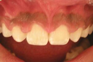 before laser periodontal therapy image