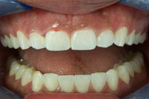 before laser periodontal therapy image