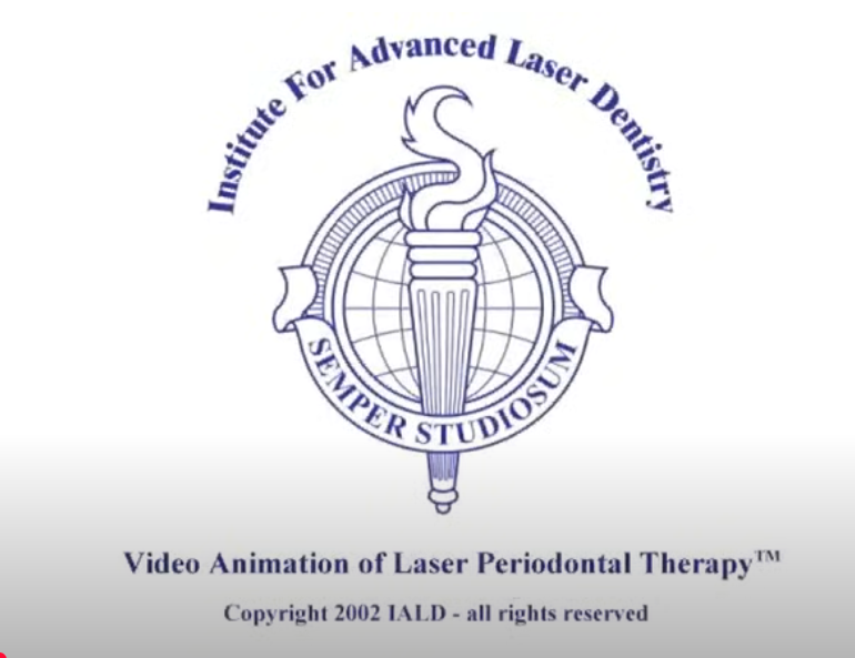 LANAP Protocol  - laser gum disease treatment
