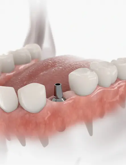 dental implant graphic