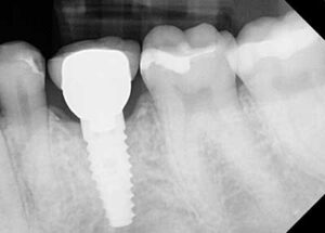 After LAPIP xray