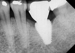 After LAPIP xray