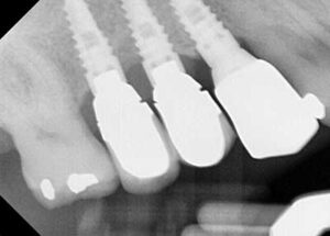 After LAPIP xray