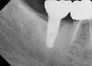 After LAPIP xray