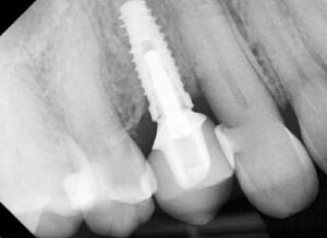 After LAPIP xray