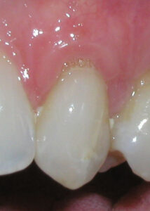 Image of a patient after treatment for Gum Recession