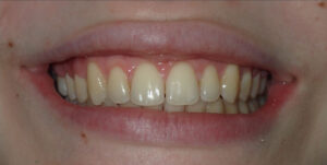 Image after a treatment for anatomic crown exposure