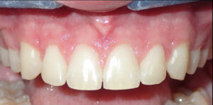 Image after a treatment for anatomic crown exposure