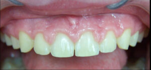 Image before a treatment for anatomic crown exposure
