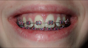 Image after a treatment for anatomic crown exposure