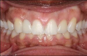 Image after a treatment for anatomic crown exposure
