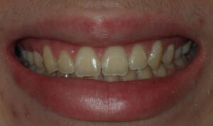 Image after a treatment for anatomic crown exposure