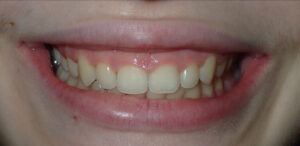 Image before a treatment for anatomic crown exposure