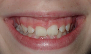 Image before a treatment for anatomic crown exposure