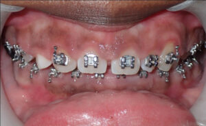 Image before a treatment for anatomic crown exposure