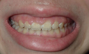 Image before a treatment for anatomic crown exposure
