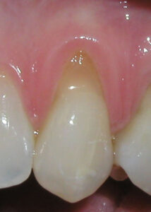 Image of a patient's gum showing Gum Recession