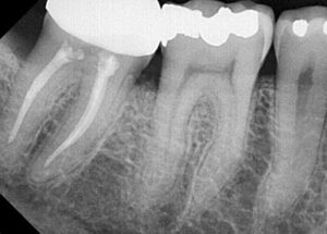xray image after bone regeneration procedure