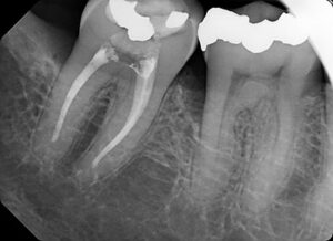 xray image showing bone loss