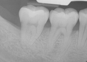 Xray image after a periodontal patient received LANAP