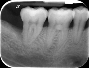 Xray image before a periodontal patient received LANAP